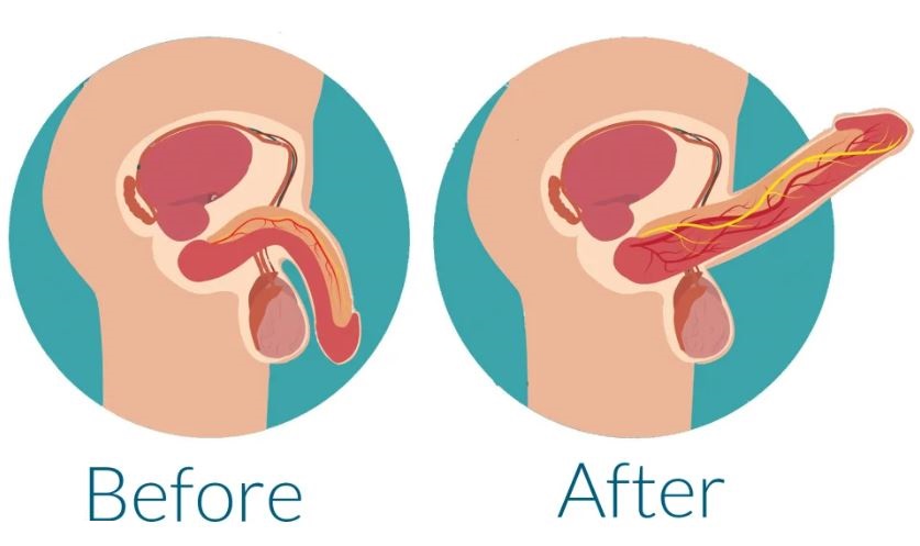 erectile dysfunction treatment Ahmedabad Gujarat